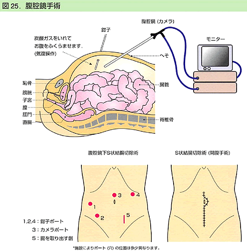図25. 腹腔鏡手術