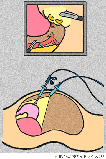 腹腔鏡下胃切除術のイメージ